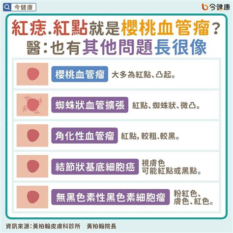 紅色痣代表什麼|身體出現的紅痣是什麼？跟皮膚癌有關嗎？醫詳解櫻桃血管瘤症狀…